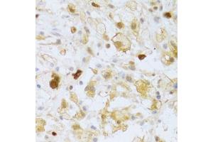 Immunohistochemistry of paraffin-embedded human brain astrocytoma using FCN1 Antibody. (FCN1 anticorps  (AA 30-326))