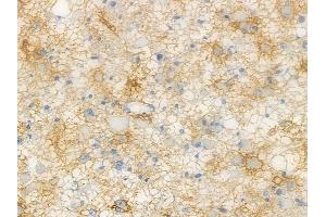 ABIN6264730 and ABIN6272560 at 1/100 staining human astrocytoma by IHC-P. (RHCG anticorps  (C-Term))