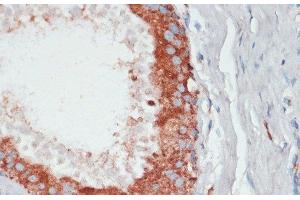 Immunohistochemistry of paraffin-embedded Human mammary cancer using PGK2 Polyclonal Antibody at dilution of 1:100 (40x lens). (PGK2 anticorps)