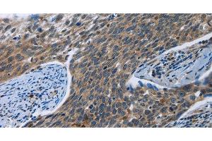 Immunohistochemistry of paraffin-embedded Human cervical cancer tissue using SYT3 Polyclonal Antibody at dilution 1:40 (Synaptotagmin 3 anticorps)