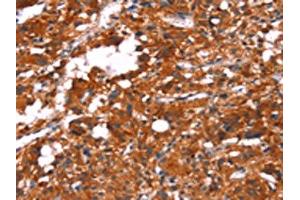 The image on the left is immunohistochemistry of paraffin-embedded Human thyroid cancer tissue using ABIN7190641(FEM1A Antibody) at dilution 1/20, on the right is treated with synthetic peptide. (FEM1A anticorps)