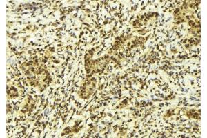 ABIN6278125 at 1/100 staining Human breast cancer tissue by IHC-P. (UNG anticorps  (Internal Region))