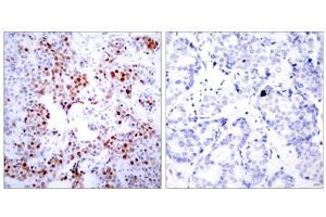 Immunohistochemical analysis of paraffin- embedded human breast carcinoma tissue using ATF-2 (Ab-69 or 51) antibody(E021030). (ATF2 anticorps)