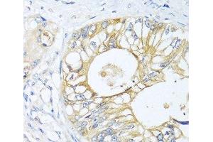 Immunohistochemistry of paraffin-embedded Human colon carcinoma using GNAI3 Polyclonal Antibody at dilution of 1:100 (40x lens). (GNAI3 anticorps)