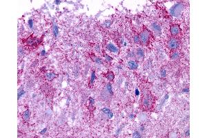 Anti-GPCR6 / GPR101 antibody IHC of human Brain, Glioblastoma. (GPR101 anticorps  (Cytoplasmic Domain))