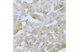 Immunohistochemistry of paraffin-embedded human liver injury using AP1M2 antibody (ABIN5974667) at dilution of 1/100 (40x lens).