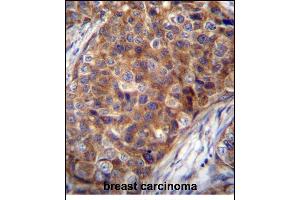 COX7A2L Antibody (Center) (ABIN656272 and ABIN2845583) immunohistochemistry analysis in formalin fixed and paraffin embedded human breast carcinoma followed by peroxidase conjugation of the secondary antibody and DAB staining. (COX7A2L anticorps  (AA 37-65))
