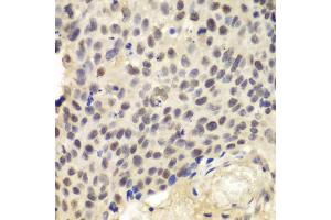 Immunohistochemistry of paraffin-embedded human lung cancer using KPNA1 antibody (ABIN5970872) at dilution of 1/100 (40x lens). (KPNA1 anticorps)