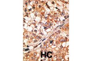 Formalin-fixed and paraffin-embedded human hepatocellular carcinoma tissue reacted with BCL2L11 polyclonal antibody , which was peroxidase-conjugated to the secondary antibody, followed by DAB staining.