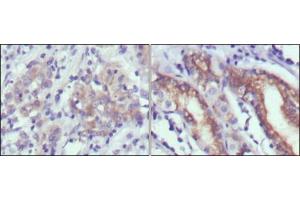 Immunohistochemical analysis of paraffin-embedded human gastric cancer (left) and normal gastric tissues (right) using CER1 antibody with DAB staining. (CER1 anticorps)
