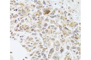 Immunohistochemistry of paraffin-embedded Human lung cancer using RNASEL Polyclonal Antibody at dilution of 1:100 (40x lens). (RNASEL anticorps)