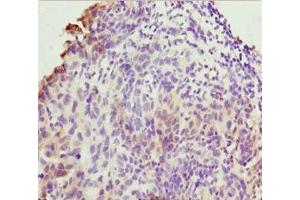 Immunohistochemistry of paraffin-embedded human bladder cancer using ABIN7173219 at dilution of 1:100 (TMEM43 anticorps  (AA 80-310))