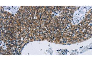 Immunohistochemistry of paraffin-embedded Human cervical cancer tissue using KPNB1 Polyclonal Antibody at dilution 1:40