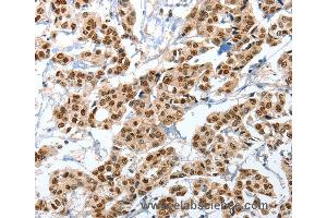 Immunohistochemistry of Human liver cancer using ANXA10 Polyclonal Antibody at dilution of 1:35 (Annexin a10 anticorps)