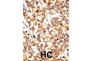 Formalin-fixed and paraffin-embedded human hepatocellular carcinoma tissue reacted with the APOBEC1 polyclonal antibody  , which was peroxidase-conjugated to the secondary antibody, followed by DAB staining. (APOBEC1 anticorps  (N-Term))