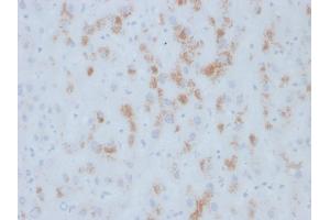 Formalin-fixed, paraffin-embedded human Hepatic Carcinoma stained with Cytochrome p450 Mouse Monoclonal Antibody (M12P4H2). (CYP2E1 anticorps  (C-Term))