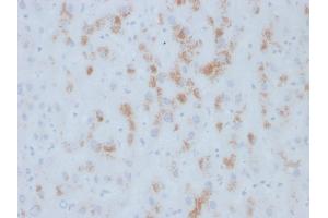 Formalin-fixed, paraffin-embedded human Hepatic Carcinoma stained with Cytochrome p450 Mouse Monoclonal Antibody (M12P4H2).