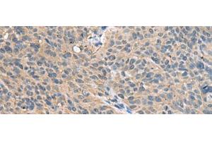 Immunohistochemistry of paraffin-embedded Human cervical cancer tissue using FAM19A4 Polyclonal Antibody at dilution of 1:55(x200)