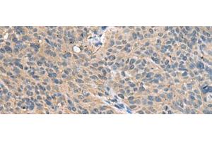 Immunohistochemistry of paraffin-embedded Human cervical cancer tissue using FAM19A4 Polyclonal Antibody at dilution of 1:55(x200) (FAM19A4 anticorps)