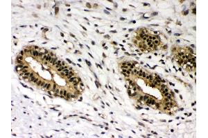 IHC(P): Human Mammary Cancer Tissue