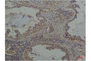 Immunohistochemistry (IHC) analysis of paraffin-embedded Human Lung Caricnoma using Phosphoserine Mouse mAb diluted at 1:200. (Phosphoserine anticorps  (phosphorylated))
