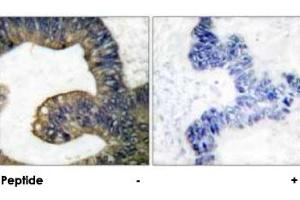 Immunohistochemical analysis of paraffin-embedded human colon carcinoma tissue using PLA2G4A polyclonal antibody . (PLA2G4A anticorps)