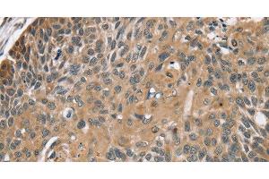 Immunohistochemistry of paraffin-embedded Human esophagus cancer using TRIM3 Polyclonal Antibody at dilution of 1:45 (TRIM3 anticorps)