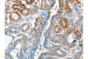 The image on the left is immunohistochemistry of paraffin-embedded Human thyroid cancer tissue using ABIN7128299(AGR3 Antibody) at dilution 1/15, on the right is treated with fusion protein. (AGR3 anticorps)