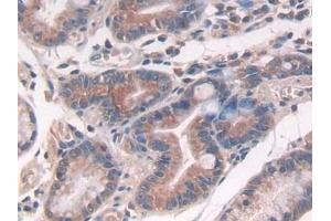 Detection of IL10 in Human Stomach cancer Tissue using Polyclonal Antibody to Interleukin 10 (IL10) (IL-10 anticorps  (AA 19-178))