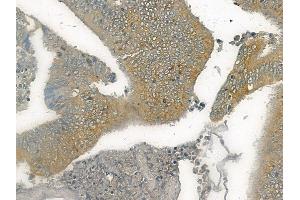 ABIN6265741 and ABIN6272531 at 1/100 staining human colon carcinoma by IHC-P. (TRIM68 anticorps  (C-Term))