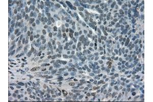 Immunohistochemical staining of paraffin-embedded Adenocarcinoma of breast tissue using anti-STAT1 mouse monoclonal antibody. (STAT1 anticorps)