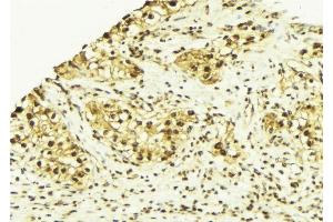 ABIN6269137 at 1/100 staining Human breast cancer tissue by IHC-P.