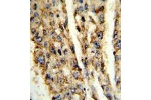 Formalin-fixed and paraffin-embedded human hepatocarcinoma reacted with DIO3 Antibody (C-term) followed which was peroxidase-conjugated to the secondary antibody, followed by DAB staining.