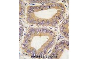 Formalin-fixed and paraffin-embedded human colon carcinoma tissue reacted with PHB2 Antibody , which was peroxidase-conjugated to the secondary antibody, followed by DAB staining.