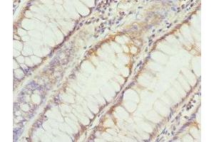 Immunohistochemistry of paraffin-embedded human colon cancer using ABIN7149608 at dilution of 1:100 (DHDDS anticorps  (AA 1-333))