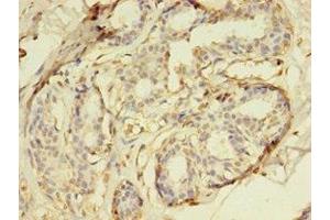 Immunohistochemistry of paraffin-embedded human breast cancer using ABIN7150765 at dilution of 1:100 (DUSP26 anticorps  (AA 1-211))