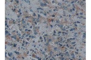 DAB staining on IHC-P; Samples: Human Prostate cancer Tissue
