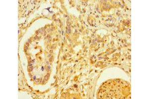 Immunohistochemistry of paraffin-embedded human pancreatic cancer using ABIN7172463 at dilution of 1:100 (TCF4 anticorps  (AA 419-525))