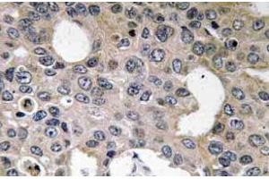 Immunohistochemistry (IHC) analyzes of CD124 / IL4R Antibody in paraffin-embedded human breast carcinoma tissue. (IL4 Receptor anticorps)