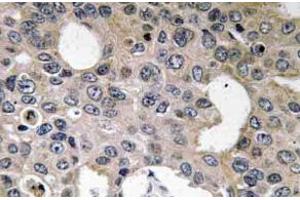 Immunohistochemistry (IHC) analyzes of CD124 / IL4R Antibody in paraffin-embedded human breast carcinoma tissue.