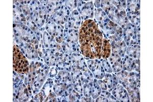 Immunohistochemical staining of paraffin-embedded Adenocarcinoma of colon tissue using anti-XRCC1mouse monoclonal antibody. (XRCC1 anticorps)