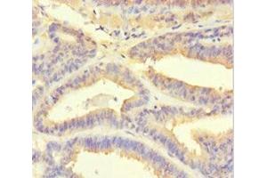Immunohistochemistry of paraffin-embedded human endometrial cancer using ABIN7164935 at dilution of 1:100 (PSMF1 anticorps  (AA 1-271))