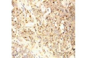 Anti-XAF1 antibody, IHC(P) IHC(P): Human Endometrial Carcinoma Tissue (XAF1 anticorps  (C-Term))