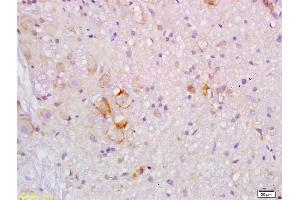 Formalin-fixed and paraffin embedded human colon carcinoma labeled with Rabbit Anti ApoB/Apolipoprotein B Polyclonal Antibody, Unconjugated (ABIN872950) at 1:200 followed by conjugation to the secondary antibody and DAB staining (APOB anticorps  (AA 1501-1700))