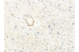 ABIN6265616 and ABIN6278288 at 1/100 staining human astrocytoma by IHC-P. (TMOD2 anticorps  (N-Term))