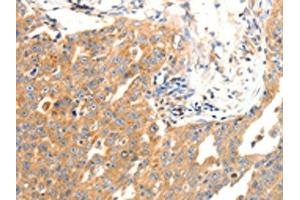 The image on the left is immunohistochemistry of paraffin-embedded Human ovarian cancer tissue using ABIN7190491(DOPEY1 Antibody) at dilution 1/25, on the right is treated with synthetic peptide. (DOPEY1 anticorps)