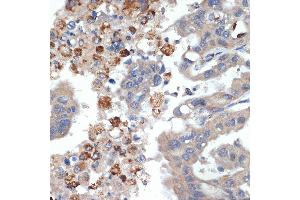 Immunohistochemistry of paraffin-embedded human liver cancer using PRSS2 Rabbit mAb (ABIN7269580) at dilution of 1:100 (40x lens). (PRSS2 anticorps)
