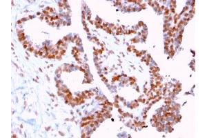 Formalin-fixed, paraffin-embedded human Prostate Carcinoma stained with CLEC9A Mouse Monoclonal Antibody (2H12/4). (DMC1 anticorps)