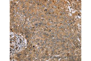 Immunohistochemistry of Human colon cancer using CLEC16A Polyclonal Antibody at dilution of 1:45 (CLEC16A anticorps)