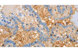 Immunohistochemistry of paraffin-embedded Human thyroid cancer using APOH Polyclonal Antibody at dilution of 1:30 (APOH anticorps)